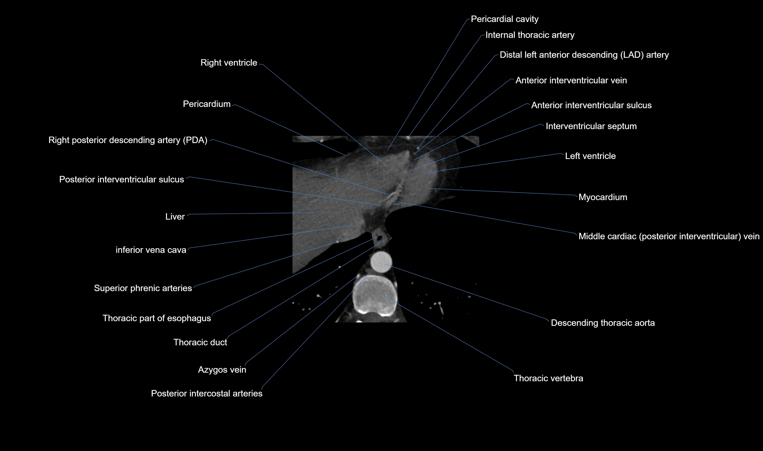 CT heart (coronary angiogram) axial view cross sectional anatomy labelled radiology image-00064.webp